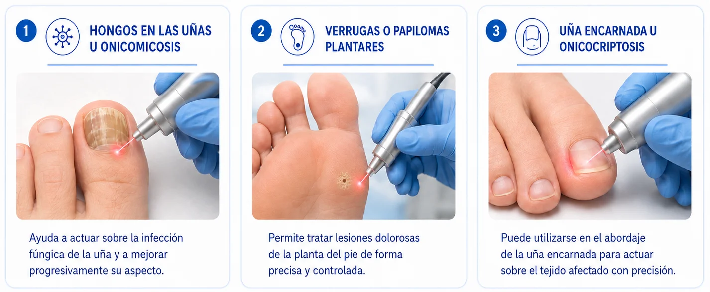 Infografía sobre tratamientos láser de uñas y verrugas